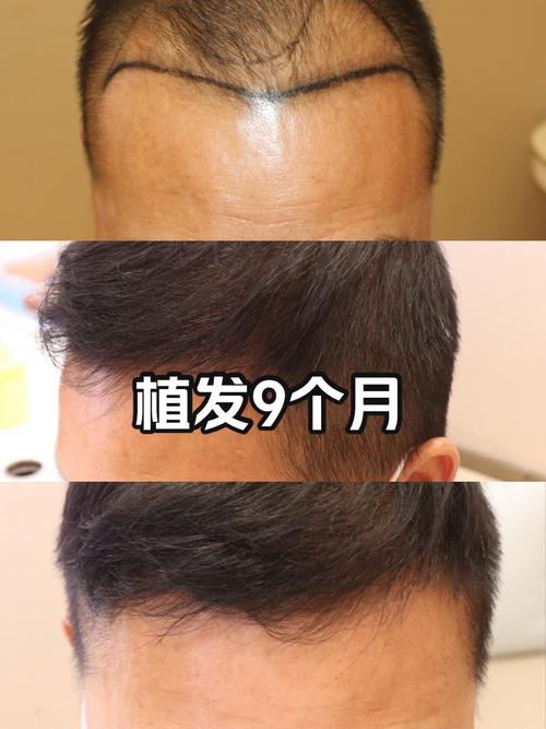 种植发多少钱一根价（种植头发一颗多少钱）